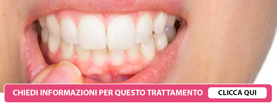 afte-dentali-lissone