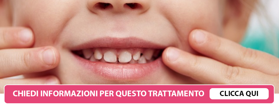 agenesie-dentali-lissone