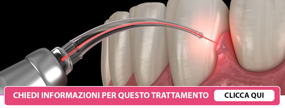 cura-parodontite-laser-lissone