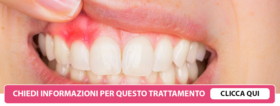 gengive-ritirate-lissone