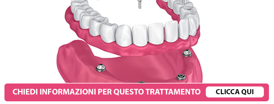 implantologia-all-on-four-lissone