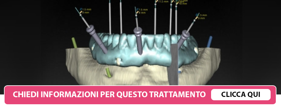 implantologia-guidata-lissone