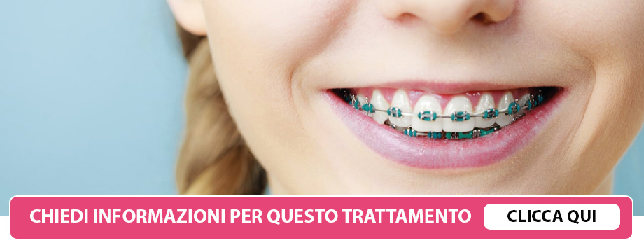Ortodonzia fissa a Lissone - Dentista Lissone - Studio Dentistico