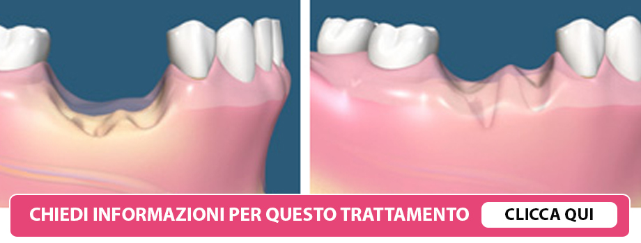 ricostruzione-osso-impianti-lissone