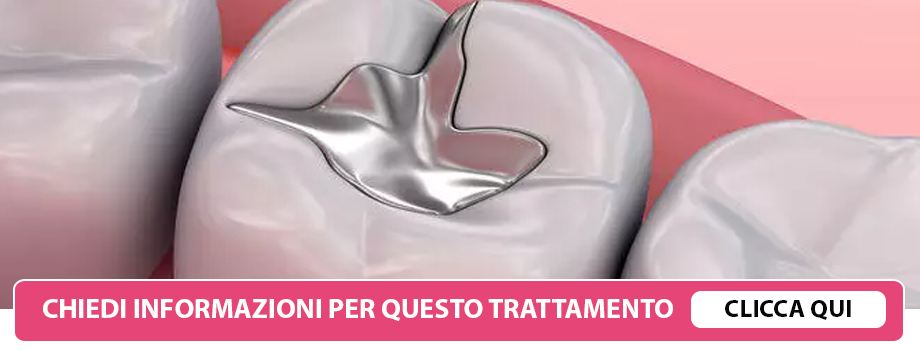 rimozione-amalgame-lissone
